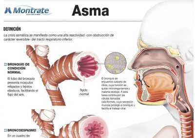 Infografía «Asma»