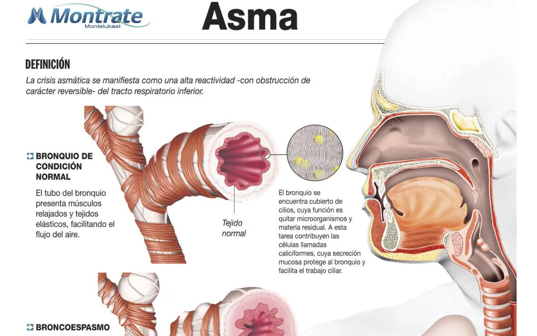 Infografía «Asma»
